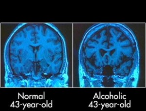 Cerebro de  un hombre de 43 años. A la izquierda, no consumidor. A la derecha, el de un alcohólico