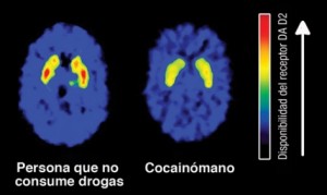 Cerebro de un cocainómano / www.drugabuse.gov