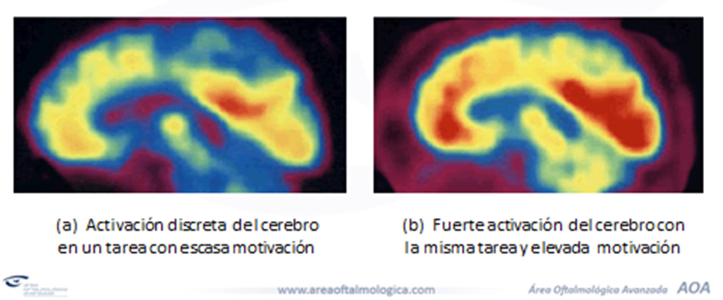 Cerebro con TDAH/ http://oftalmologia-barcelona.com
