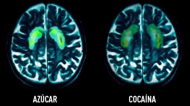 cerebro y azúcar